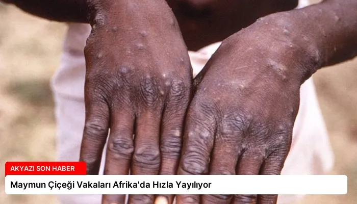 Maymun Çiçeği Vakaları Afrika’da Hızla Yayılıyor